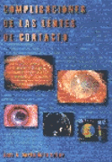 COPLICACIONES DE LAS LENTES DE CONTACTO