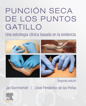 PUNCI�N SECA DE LOS PUNTOS DE GATILLO